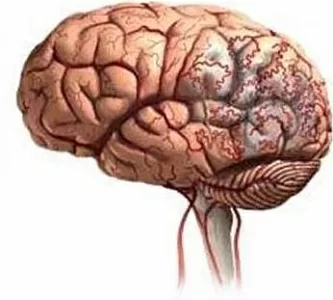 Тромбоз сосудов головного мозга: симптомы и лечение